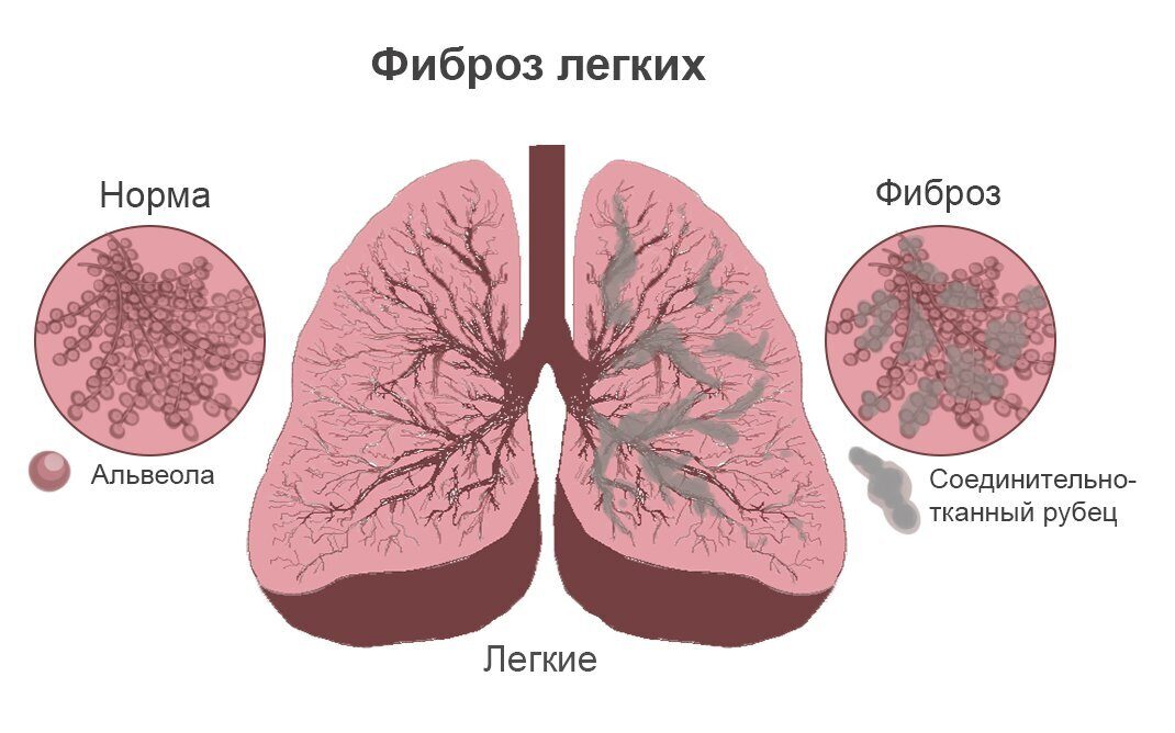 Пневмония: симптомы и лечение